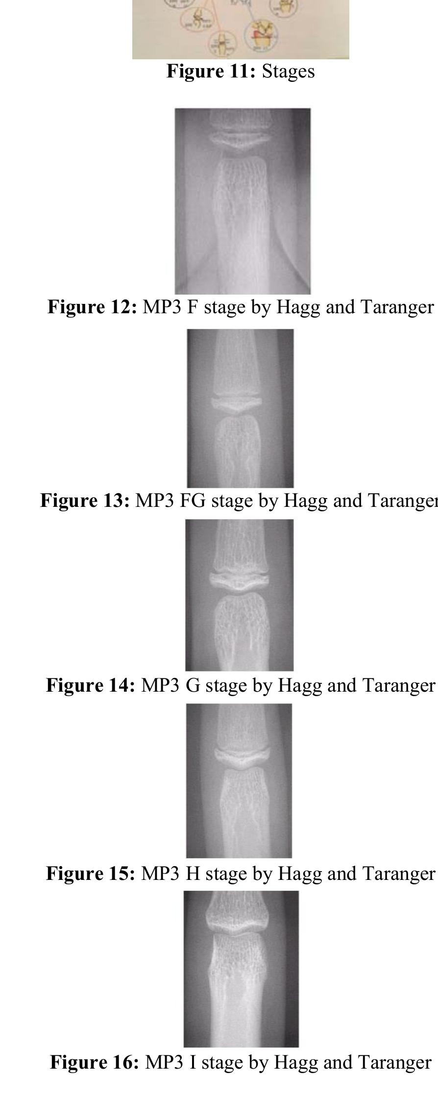Figure 3 - from Skeletal Maturity Indicators-Review
