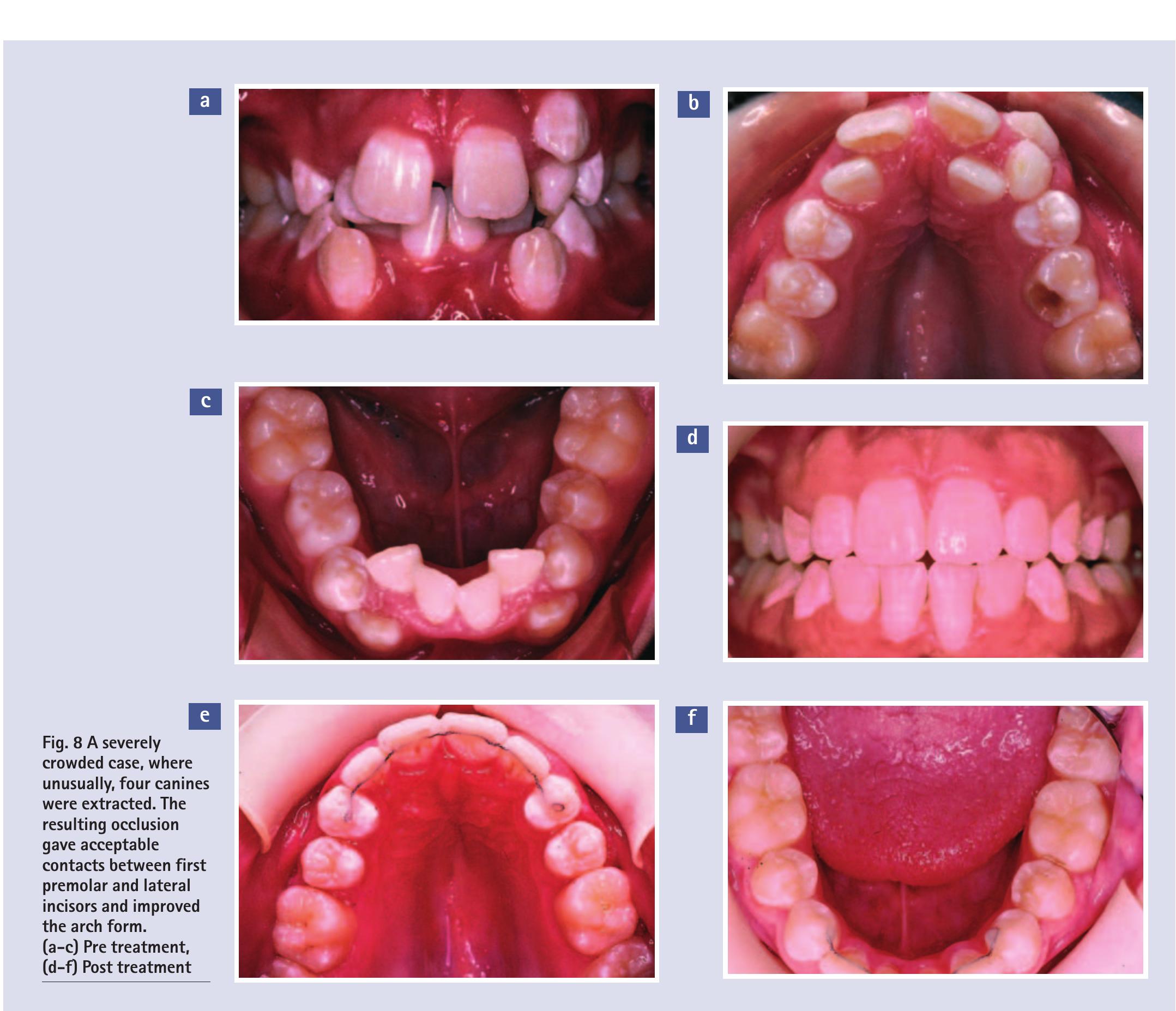 Messially Angulated (PDF) Orthodontics. Part 8: Extractions in orthodontics