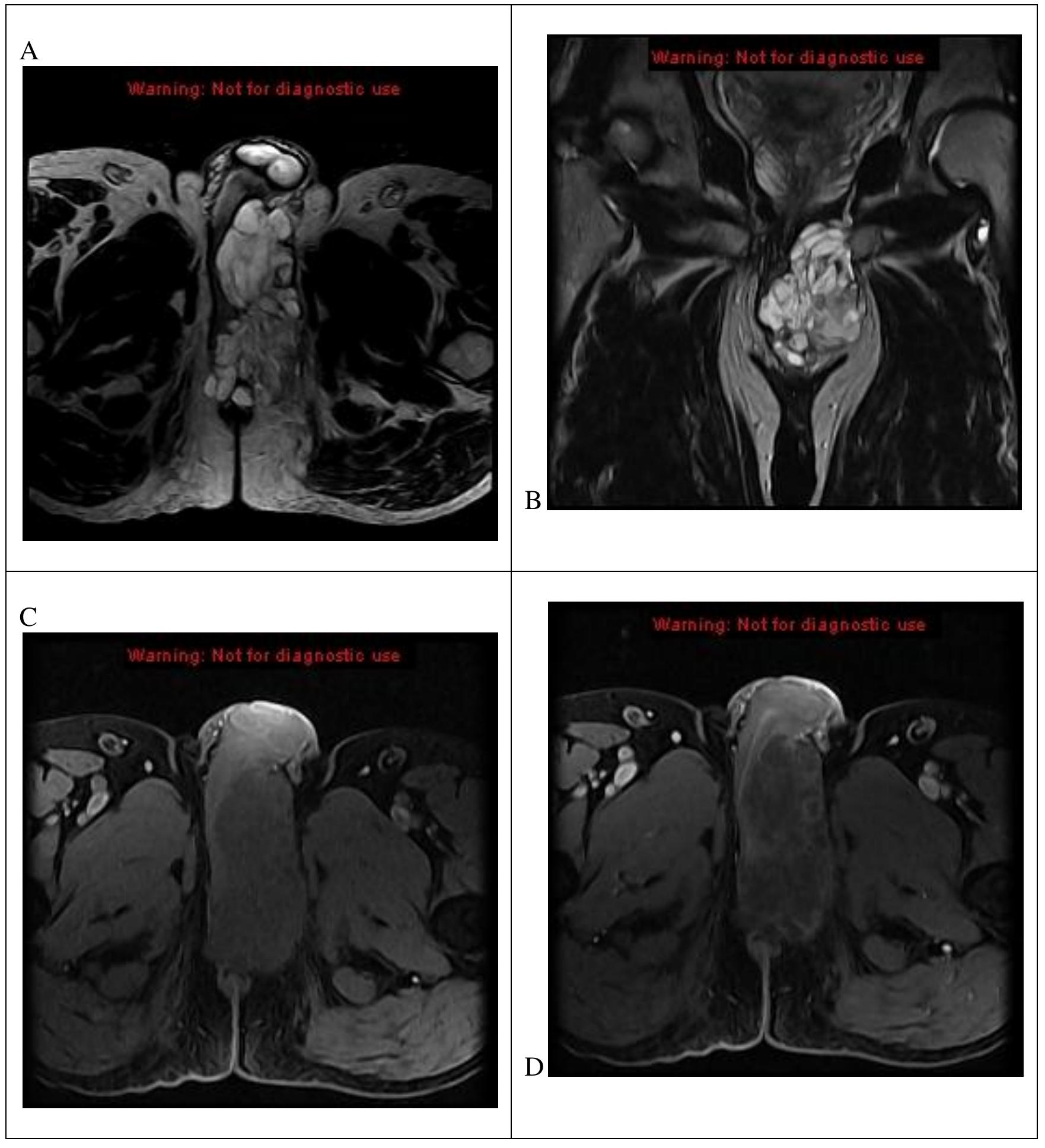 (PDF) Primary Mucinous Carcinoma of Cowper' gland: A Case Report of a ...