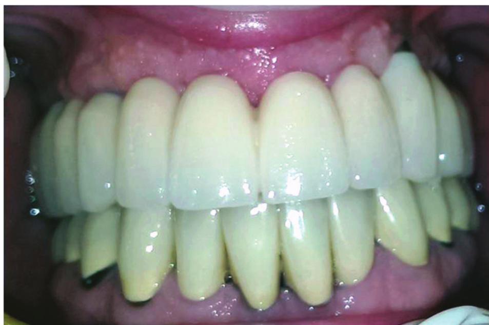 Figure 4 - from Implant-Supported CAD/CAM Full-Arch Zirconia