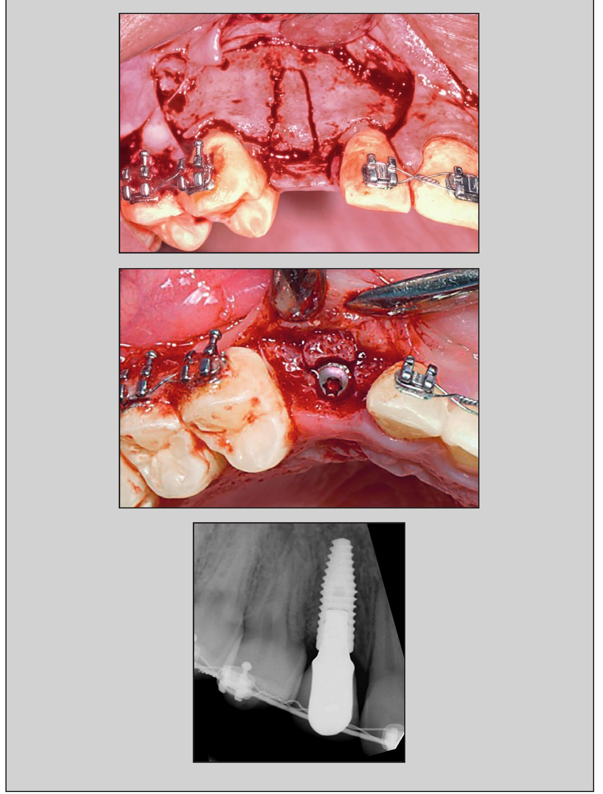 Split Ridge Maxilla Figure 1 - from The Custom Alveolar Ridge-Splitting (CARS)