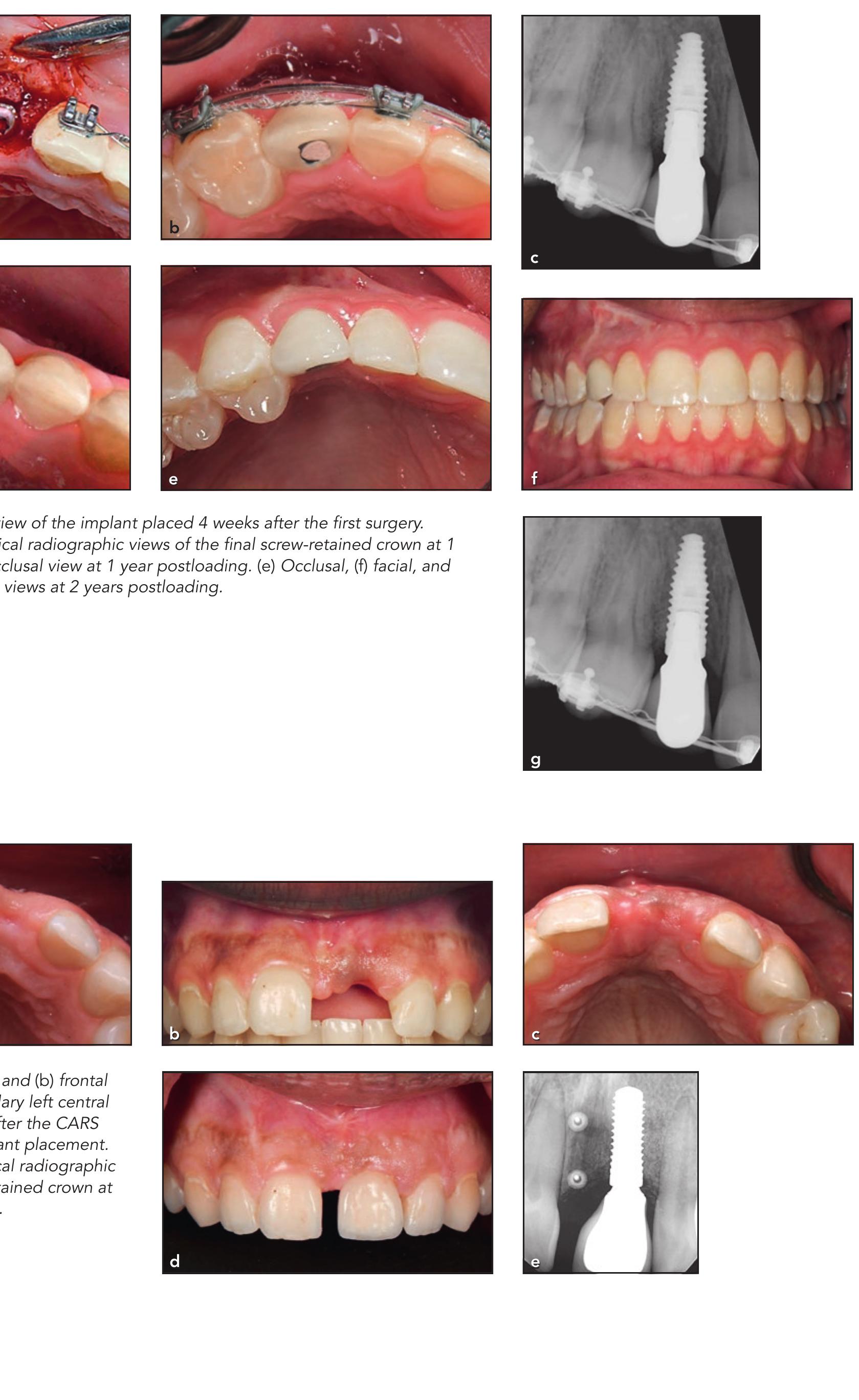 Figure 6 - The Custom Alveolar Ridge-Splitting (CARS)