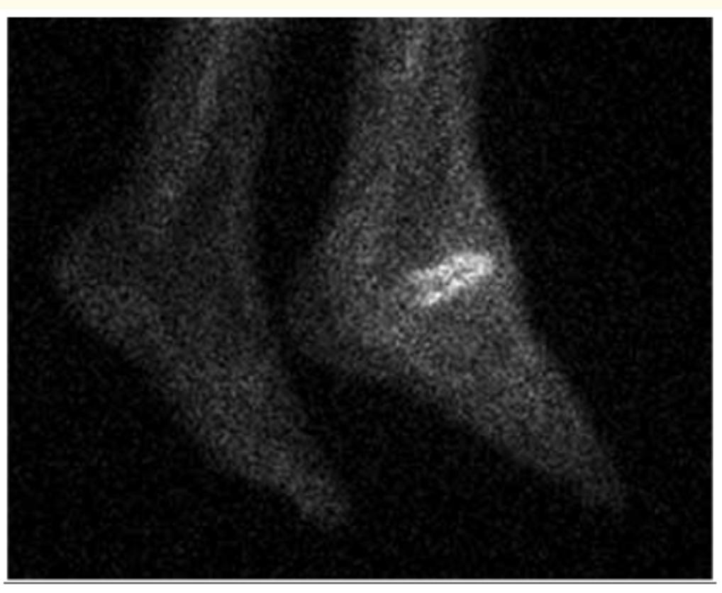 Indium Scanner Figure 14 - from EC GASTROENTEROLOGY AND DIGESTIVE SYSTEM
