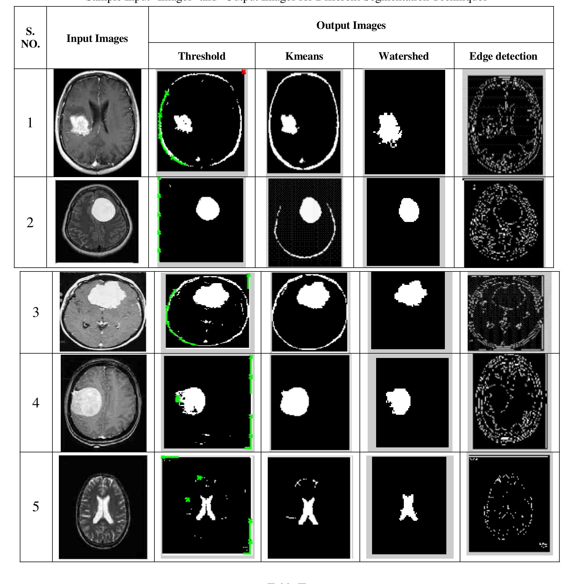 (PDF) Brain Tumour Detection Using Image Segmentation: A Review