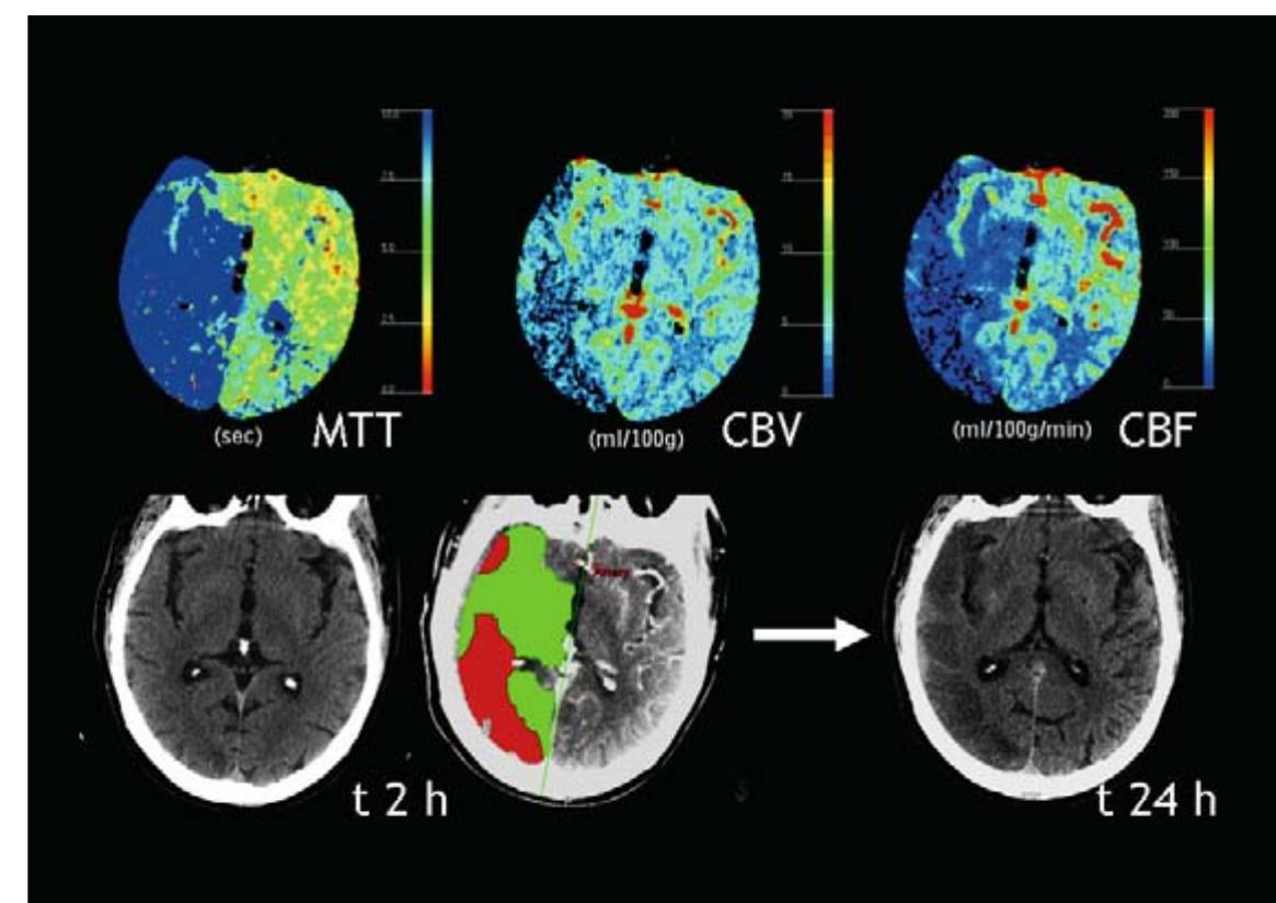 Figure 8 - Brain perfusion CT: principles, technique and