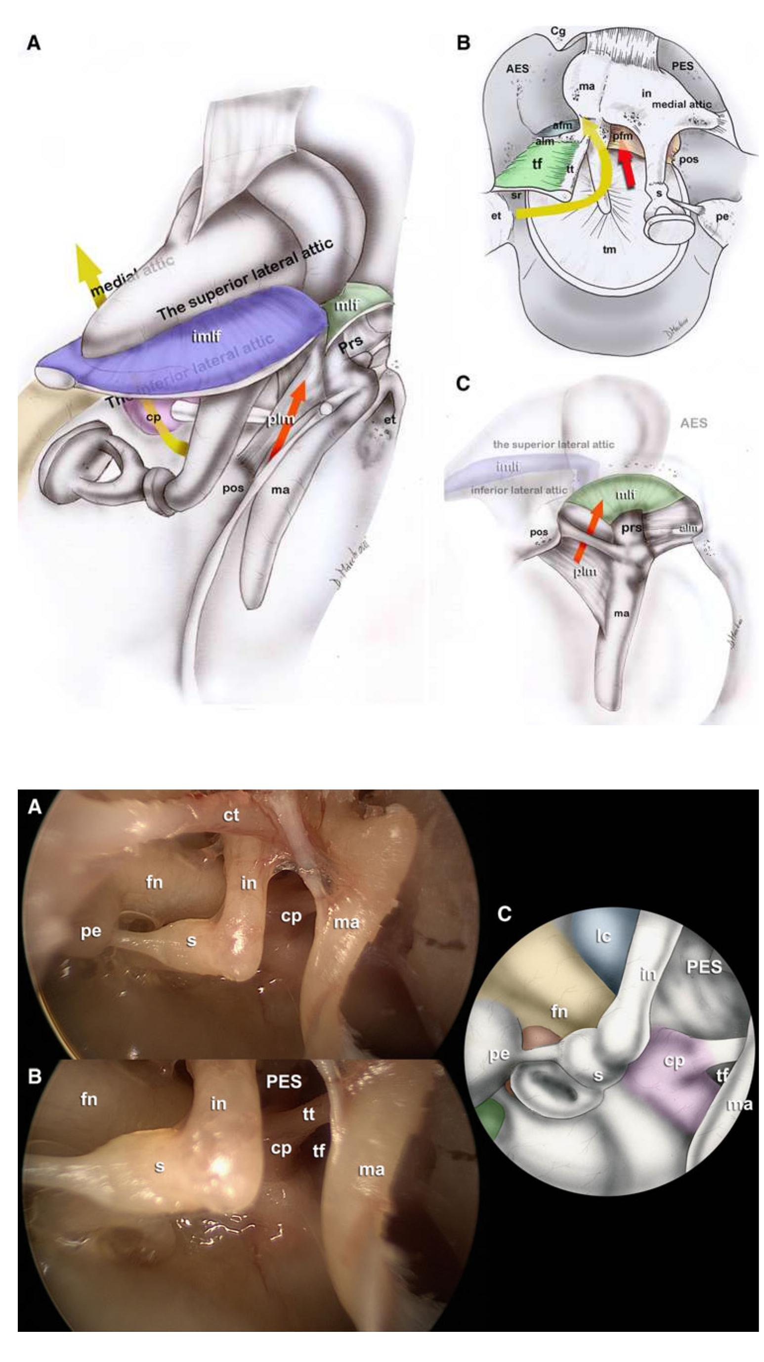 Figure 6 - from [Endoscopic anatomy of the middle ear]