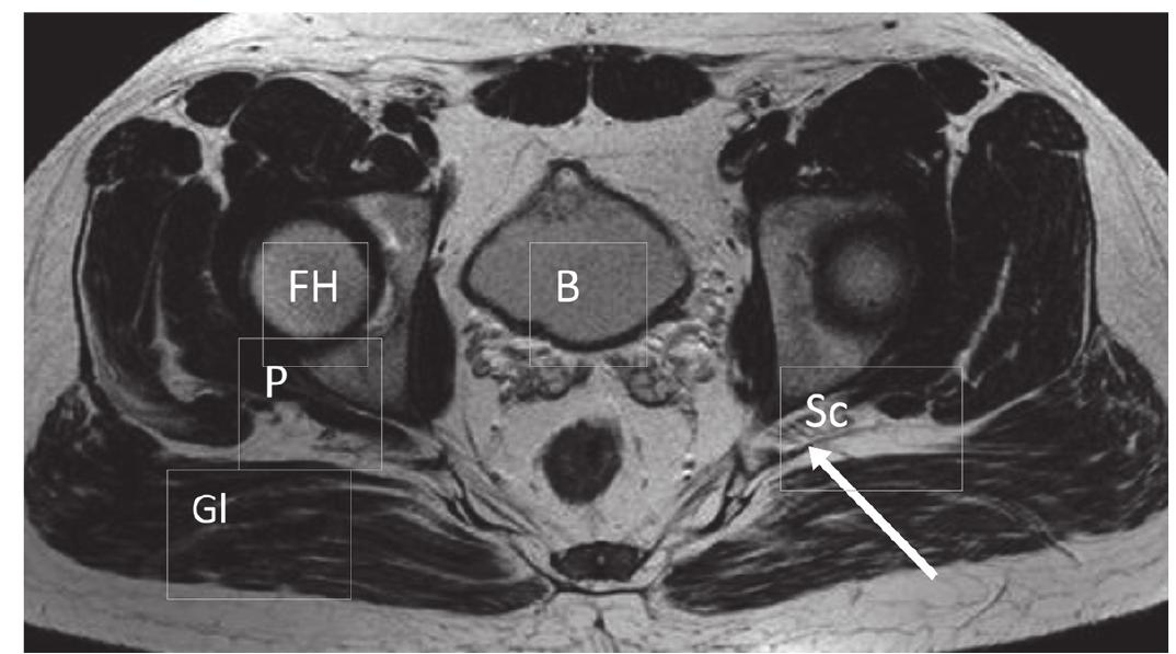 A. t2 w tse axial mri of the pelvis of a forty nine year-