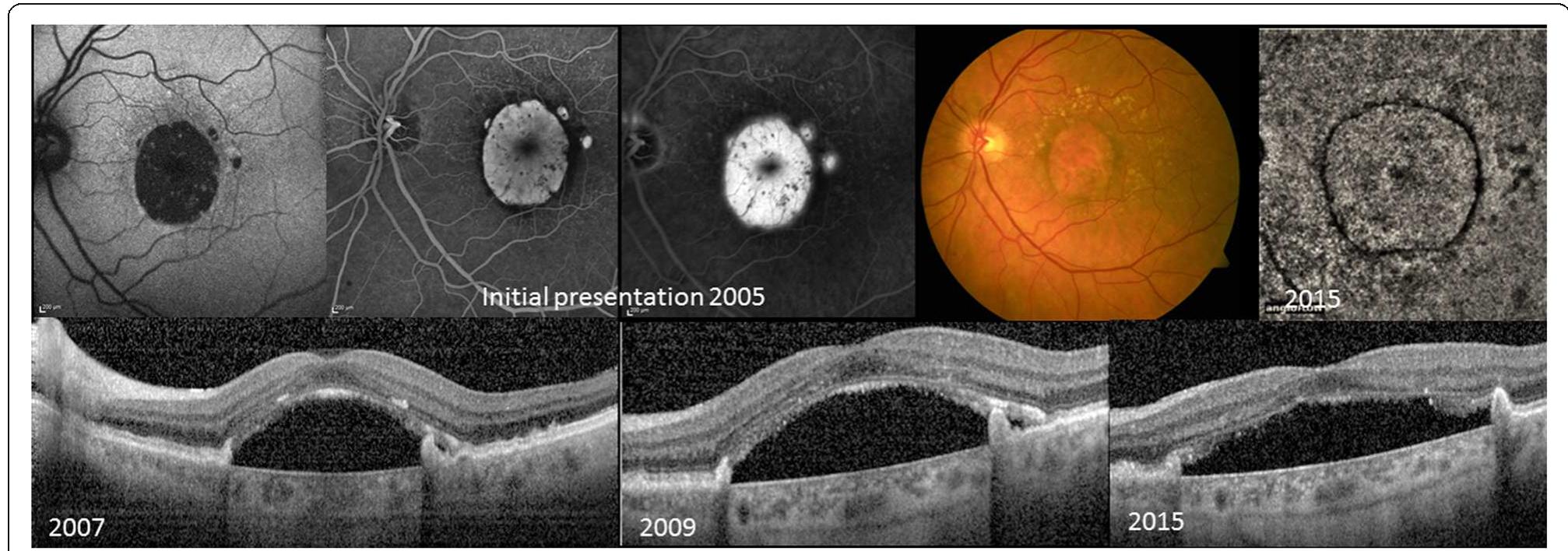 (PDF) Atypical retinal pigment epithelial defects with retained ...