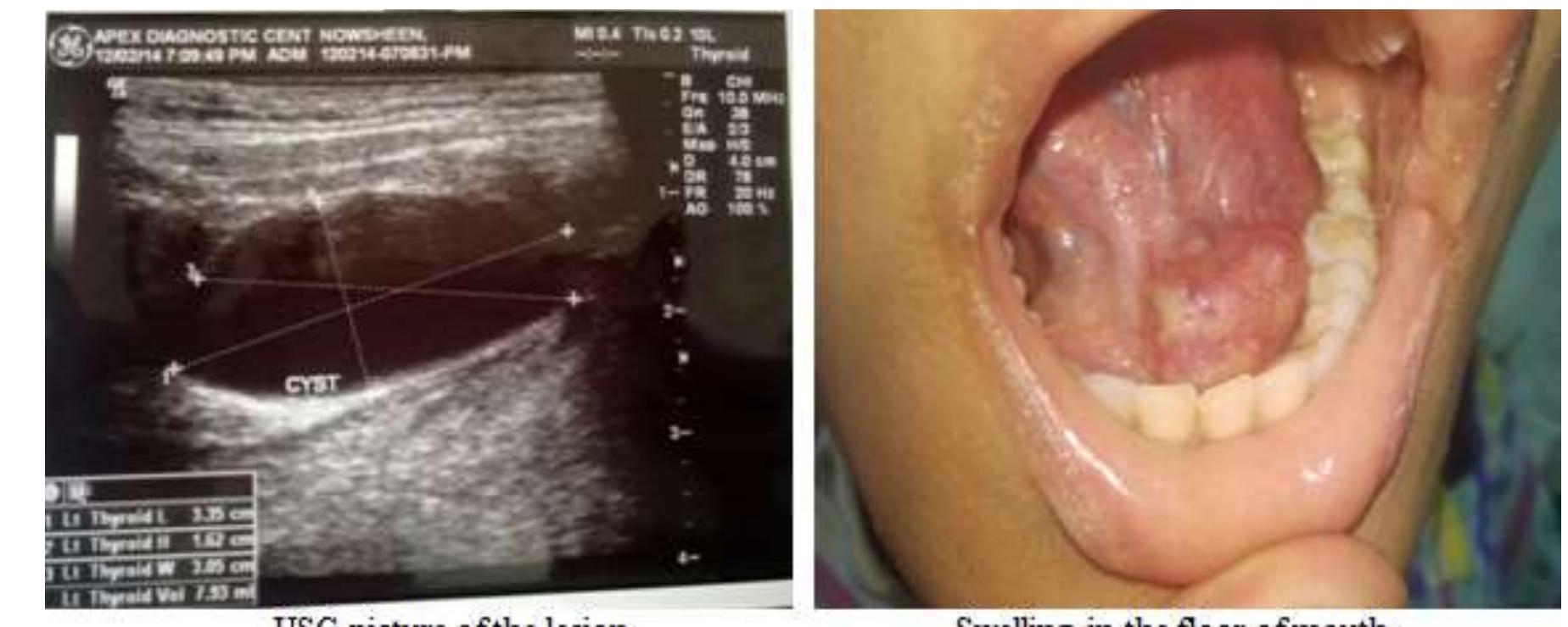 (PDF) Ranula-Recommended Radiology and Management Dr