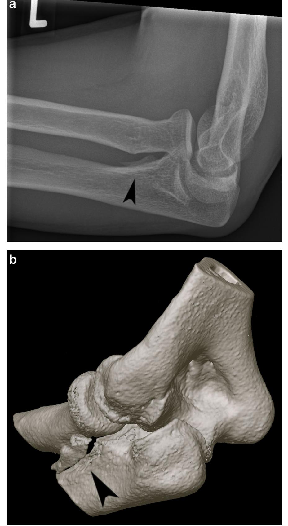 (PDF) vulsion fracture of the supinator crest as an indication for a ...