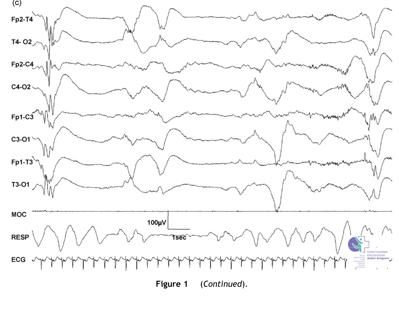 (PDF) Normal EEG of premature infants born between 24 and 30 weeks ...