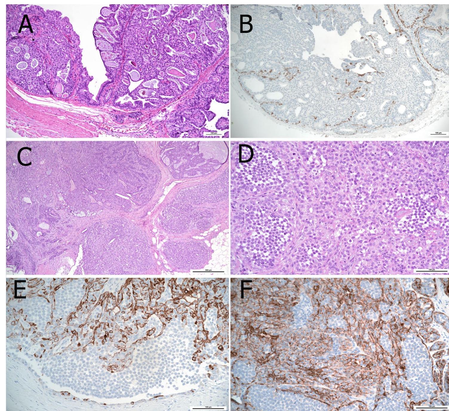 (PDF) Papillary lesions of the breast