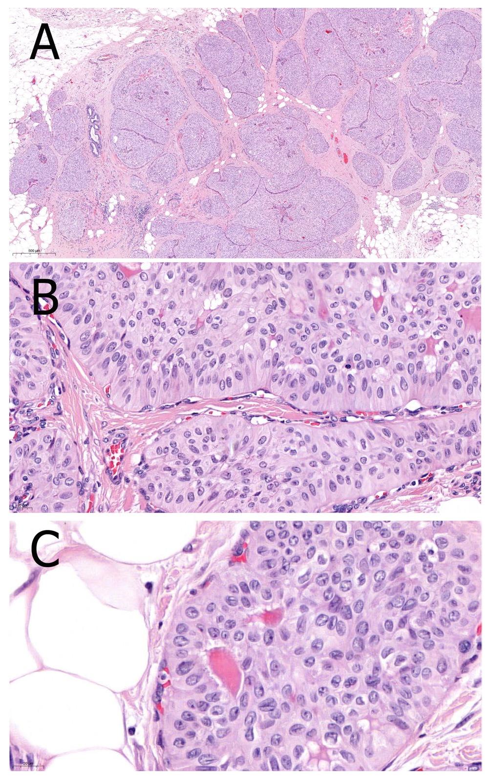 (PDF) Papillary lesions of the breast