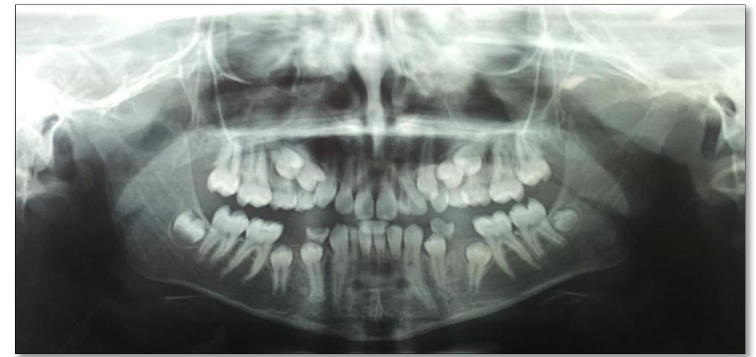 Figure 4 - from Multiple Developmental Dental Anomalies in a
