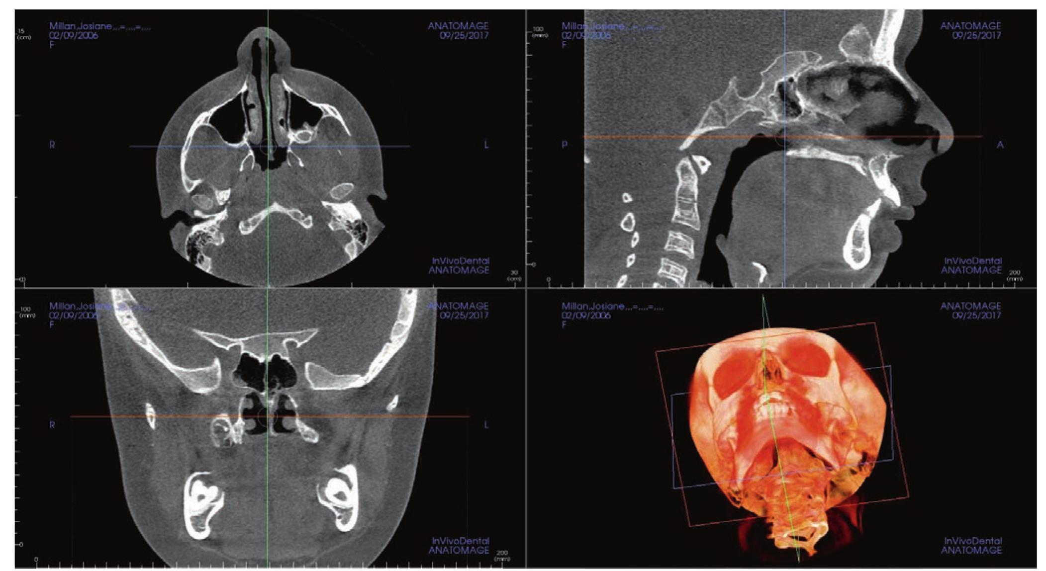 1 cone beam ct of a patient showing the three planes and the