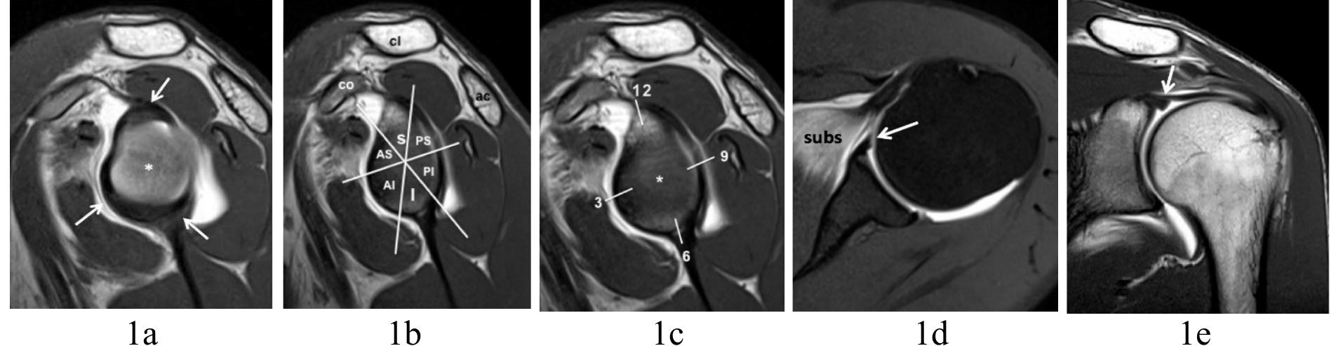 Labeled Sholder Anthrogram (PDF) Imaging of the Shoulder Bankart Lesion and its Variants