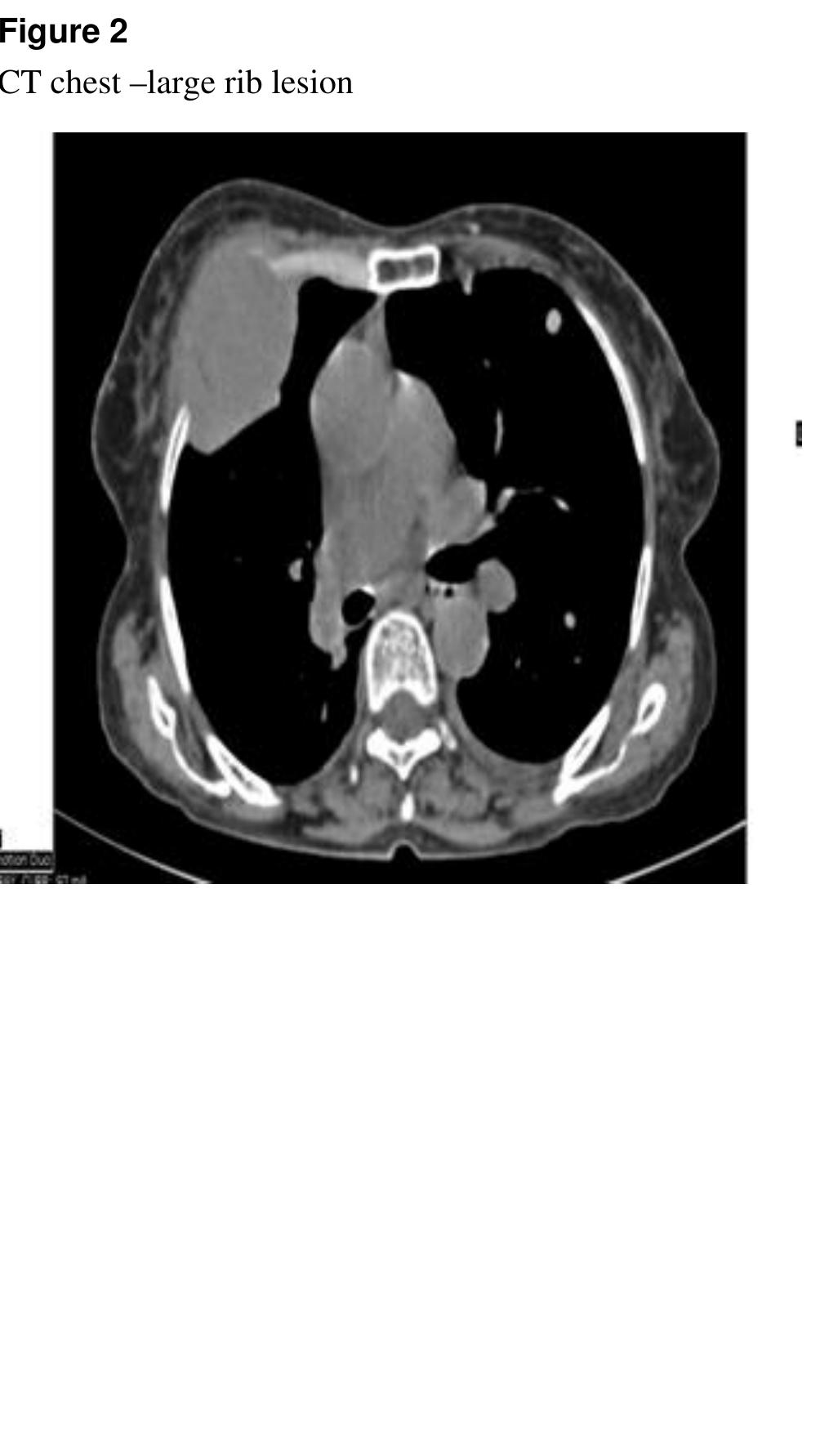 (PDF) Occult Follicular Thyroid Carcinoma Presenting As Chest Wall ...