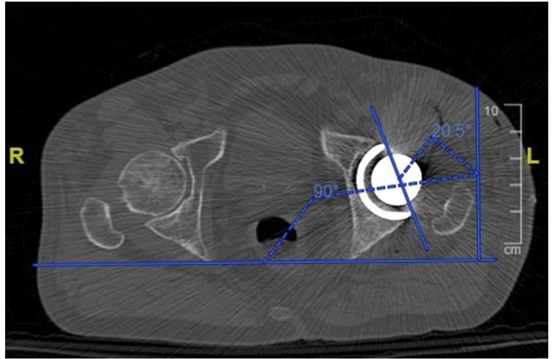 Measurement of the acetabular cup anteversion angle on a