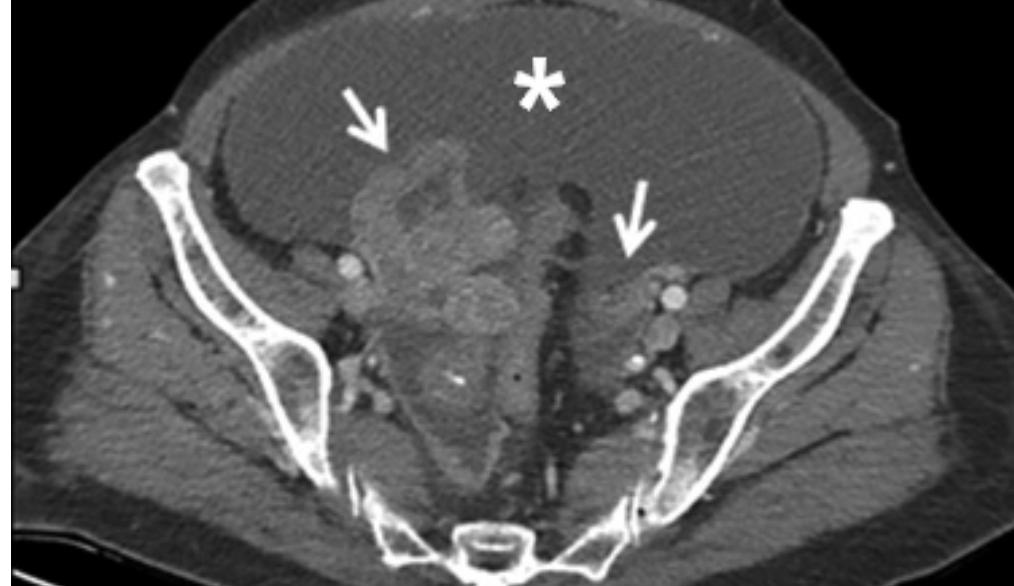 Venous phase image of abdominopelvic ct shows bilateral sol-