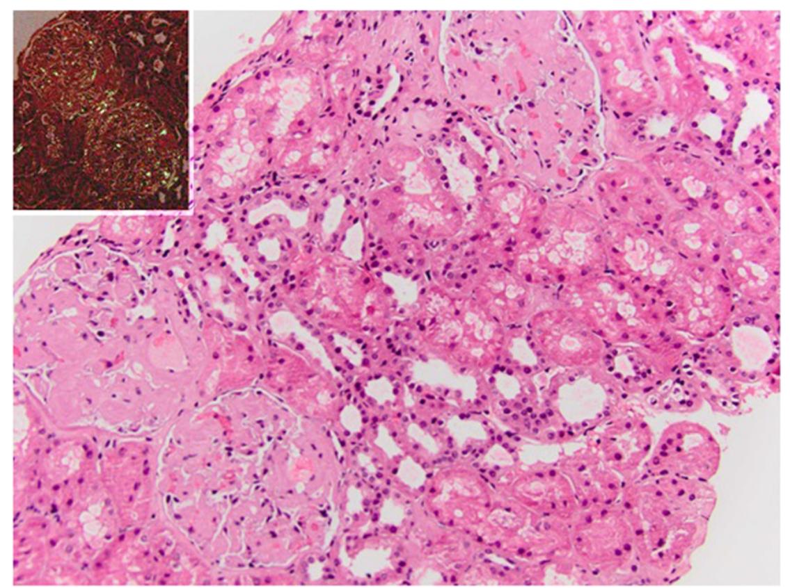 Renal biopsy with insert demonstrating amyloid deposits