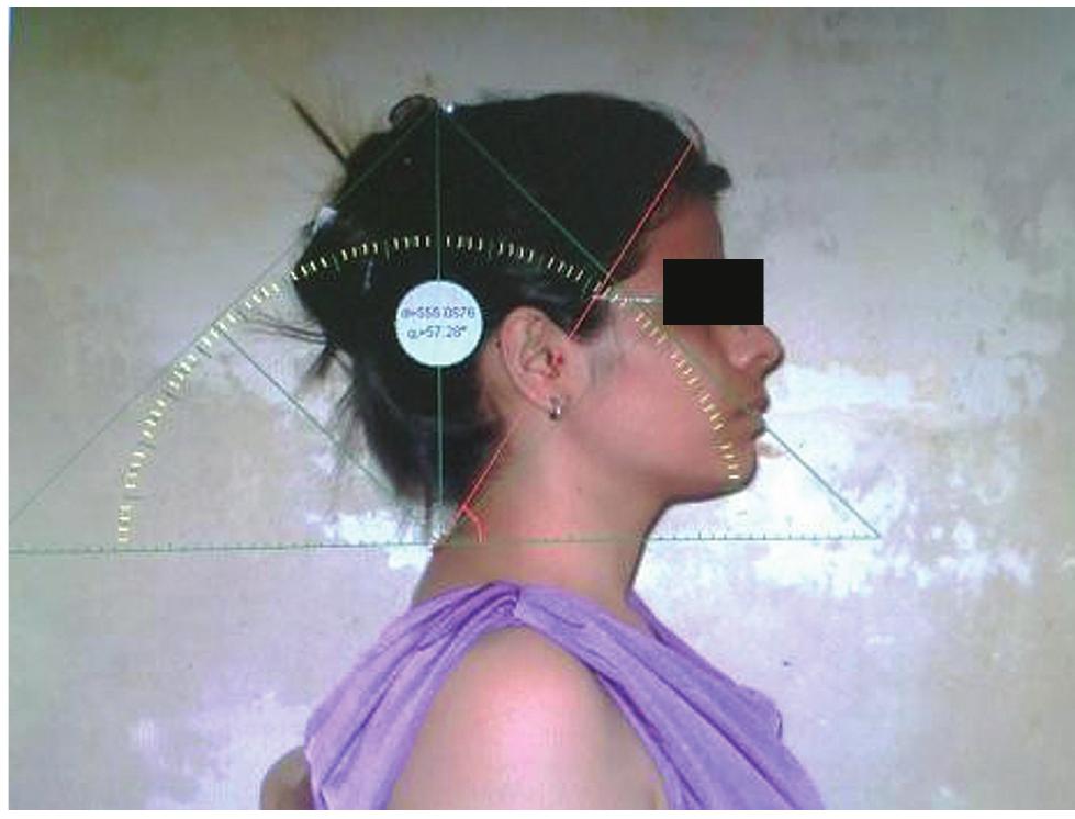 (PDF) Reliability of “MB-Ruler Software” to Measure Craniovertebral ...