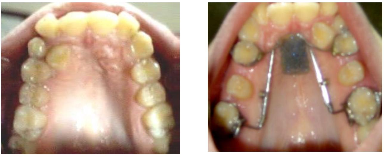 Distalisation Jet Figure 4 - Distal jet versus first class appliance for