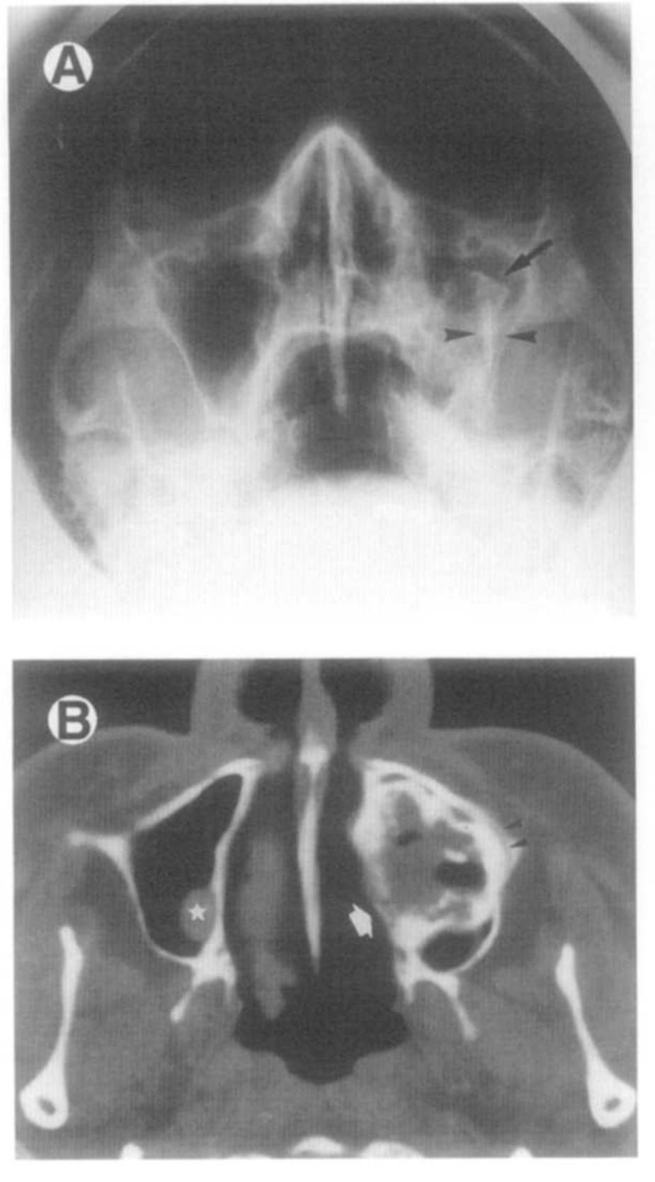 (PDF) Maxillary sinus ossifying fibroma