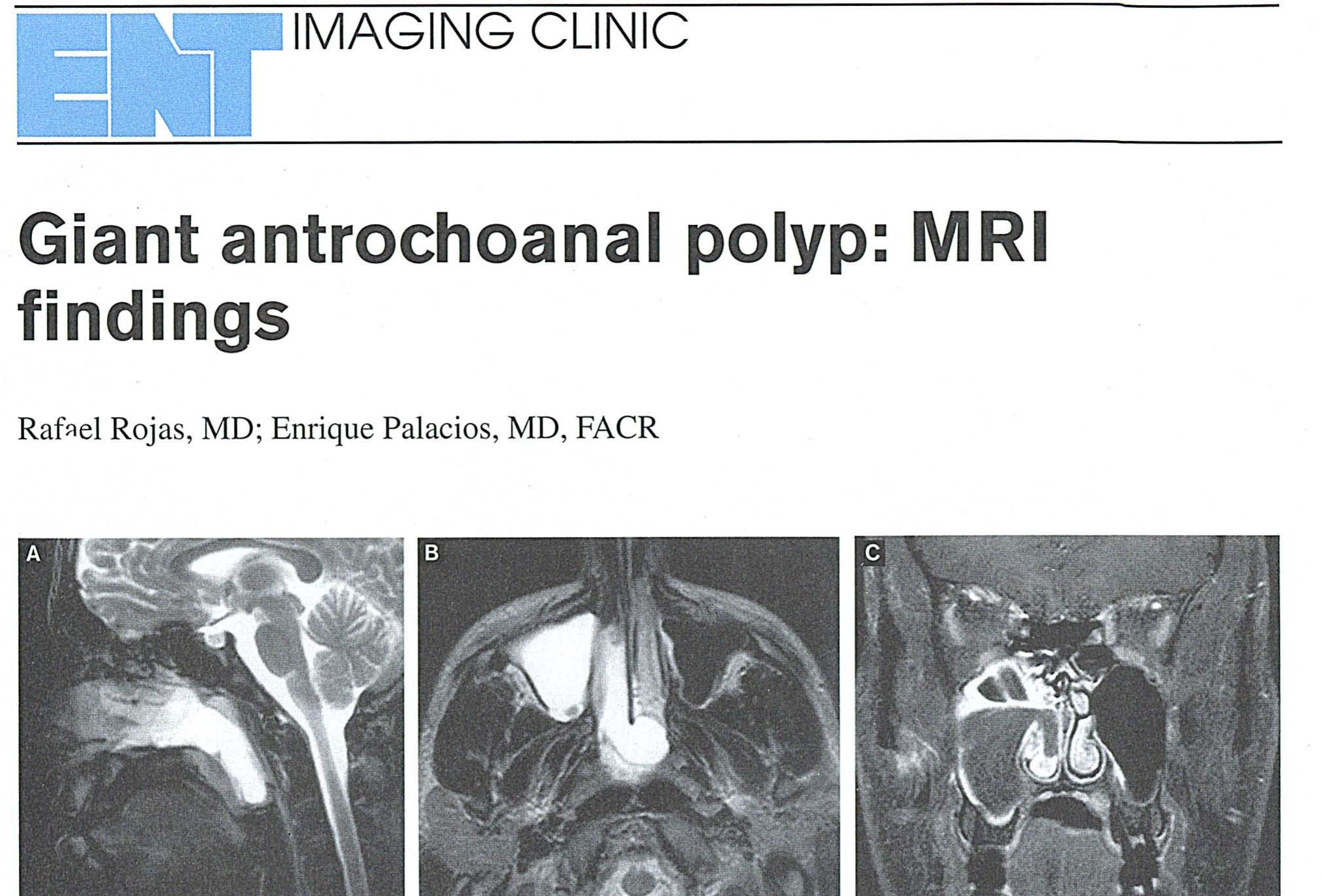 (PDF) Giant antrochoanal polyp: MRI findings