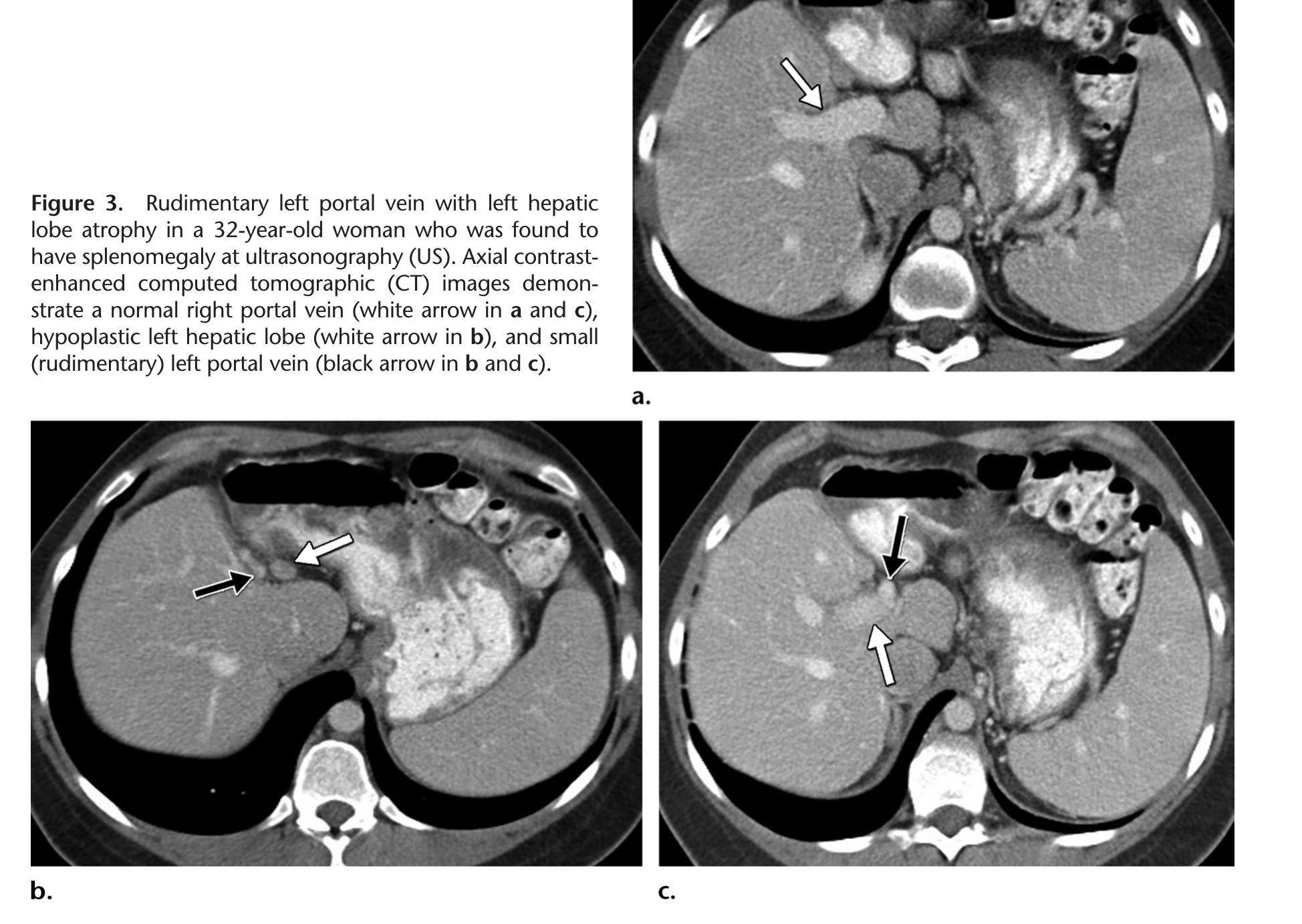 Figure 1 - from Hepatic vascular diseases: CT and MRI