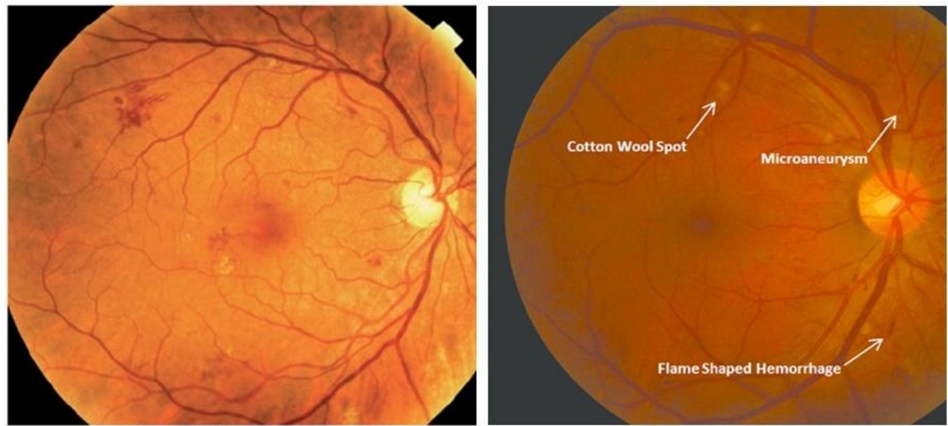 Figure 10 - from Detection of retinal abnormalities in