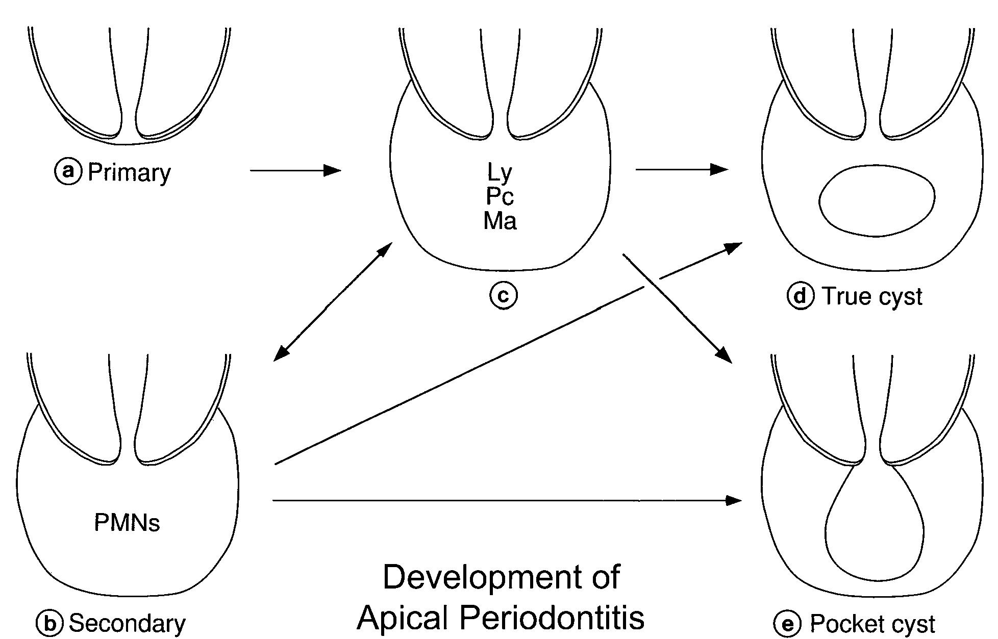 (PDF) Pathogenesis of apical periodontitis and the causes of endodontic ...