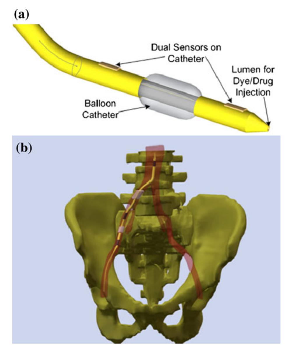 Smart Cateter (PDF) Flexible Thin-Film PVDF-TrFE Based Pressure Sensor for Smart ...
