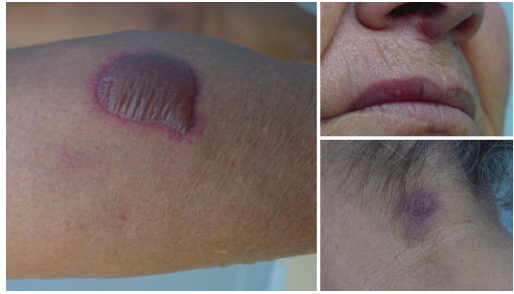 Tnf Drug Rash 21 multiple lesions of fixed drug eruption in a patient
