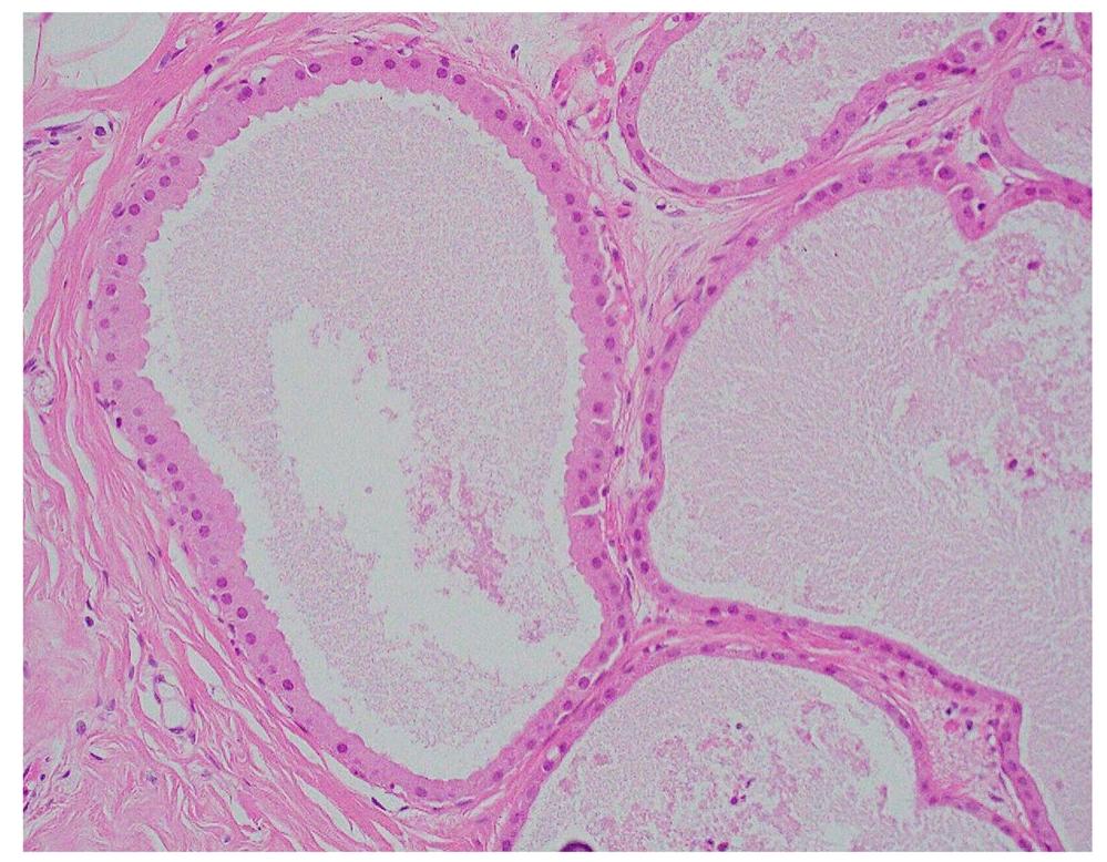 (PDF) Apocrine lesions of the breast