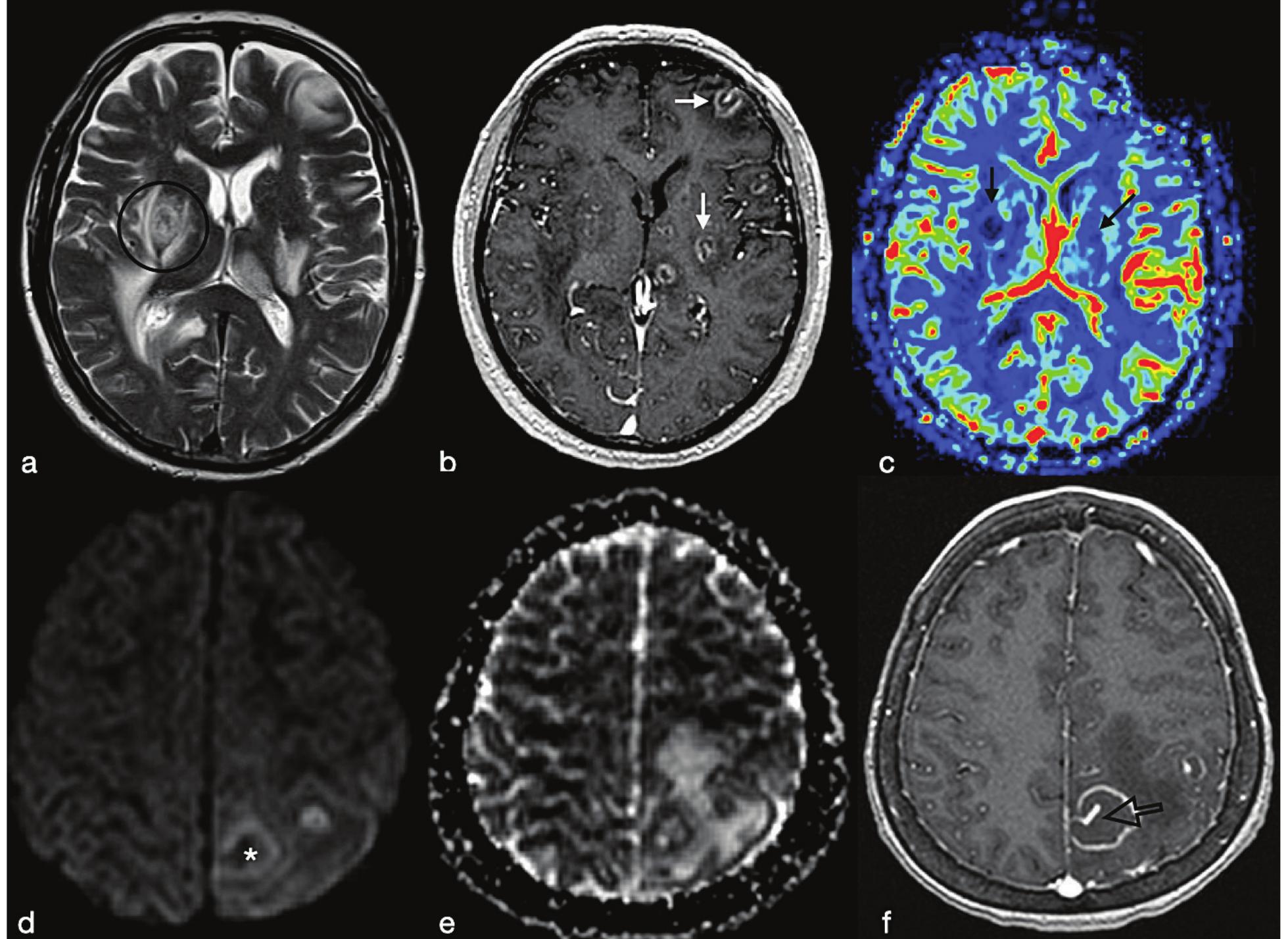 (PDF) Cerebral abscesses imaging: A practical approach