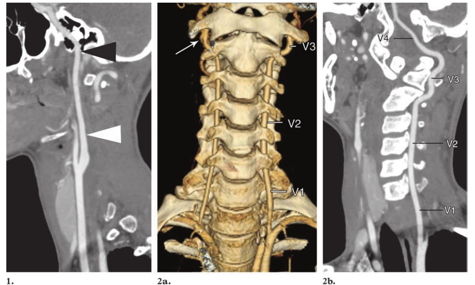 Ica Dissection Grading Figure 19 - from Craniocervical Arterial Dissection: