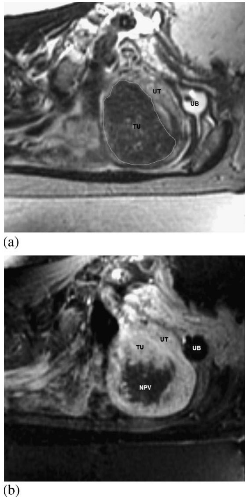 Magnetic resonance imaging (mri) of the pelvis before (a)