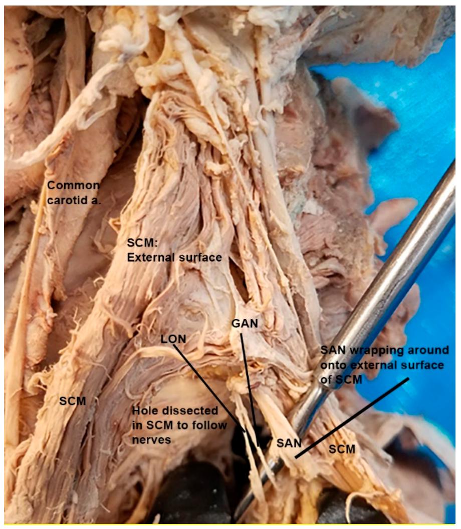Figure 1. Dissection photo showing the spinal accessory nerve (SAN) as it pierces the sternocleido- mastoid (SCM) and then wraps back superiorly towards the base of the scalp. A separation of the SCM was performed to allow for tracking and visualization of the course of the SAN as it traveled through the muscle. 