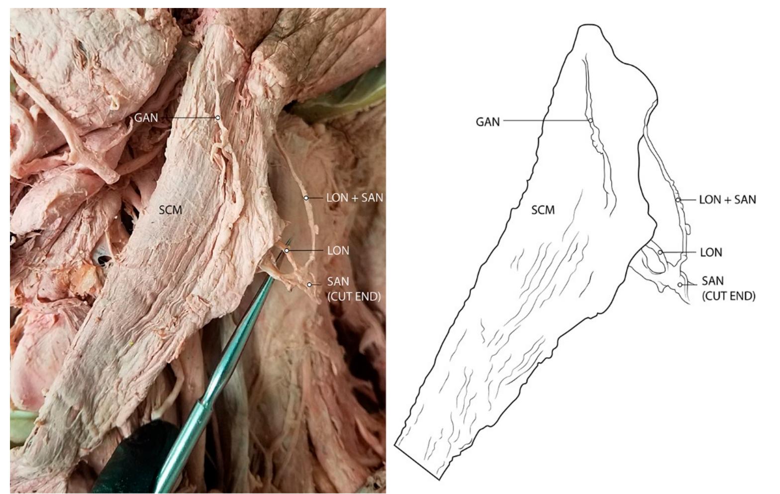 Figure 2. Cadaveric photo of connection between spinal accessory nerve (SAN) and lesser occipital nerve (LON), both of which pierce through the sternocleidomastoid. In this individual, the GAN also pierces the SCM, but does so separately from the SAN. Abbreviations: GAN = greater auricular nerve; LON = lesser occipital nerve; SAN = spinal accessory nerve; SCM = sternocleidomastoid. 