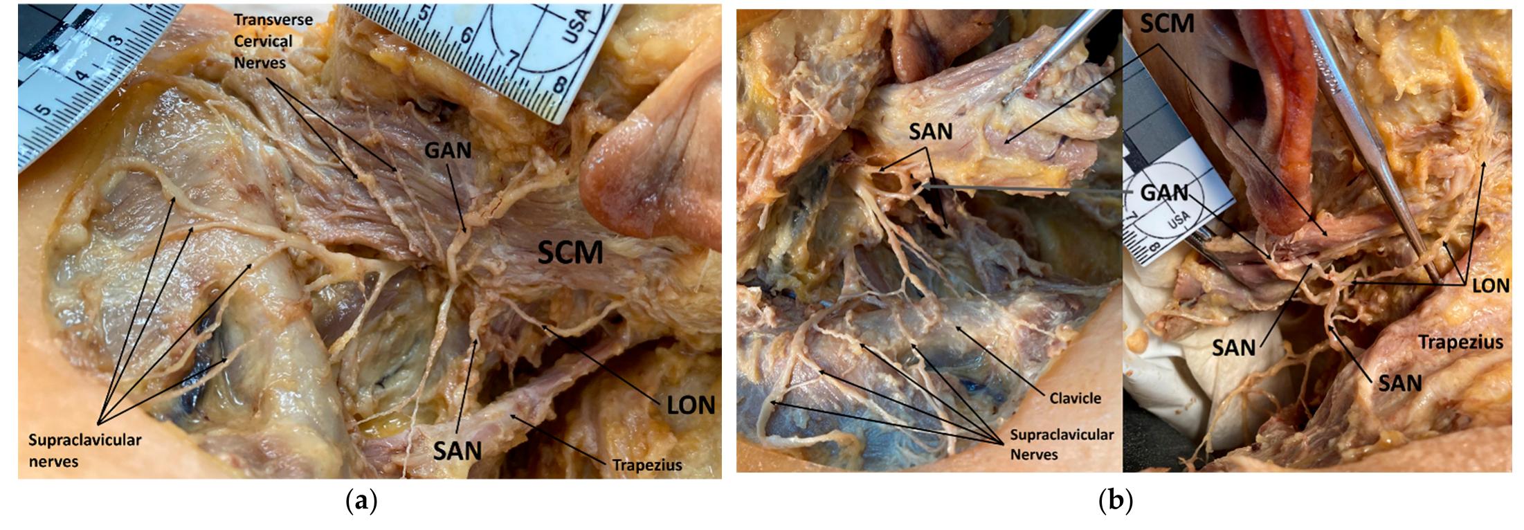 Figure 3. Cadaveric photo of left cervical and auricular regions showing variant with spinal ac- cessory nerve (SAN) sending a small branch to join the lesser occipital nerve (LON): Superficial view (a) and deep view (b). Abbreviations: GAN = great auricular nerve; LON = lesser occipital nerve; SAN = spinal accessory nerve (CN XI); SCM = sternocleidomastoid. 