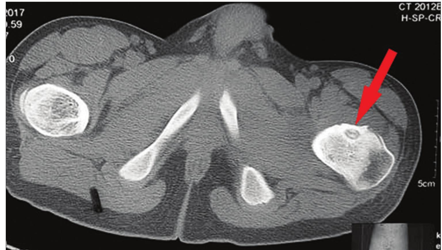 (PDF) Arthroscopic Excision of Osteoid Osteoma of the Femoral Neck