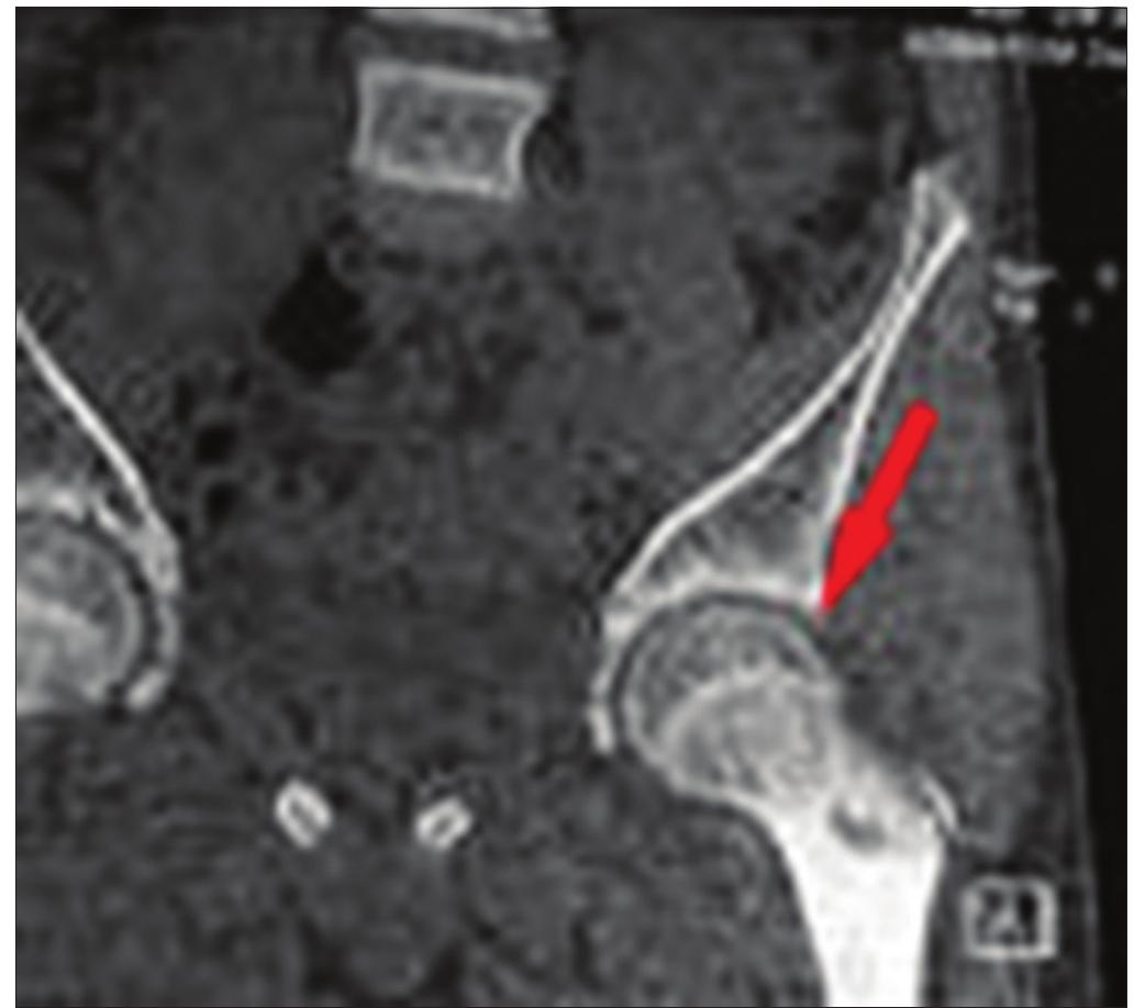 (PDF) Arthroscopic Excision of Osteoid Osteoma of the Femoral Neck