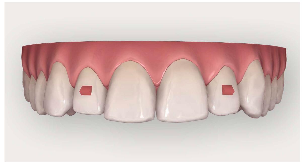 Spring Effect Attachments Invisalign (PDF) Efficacy of Invisalign attachments: A retrospective study