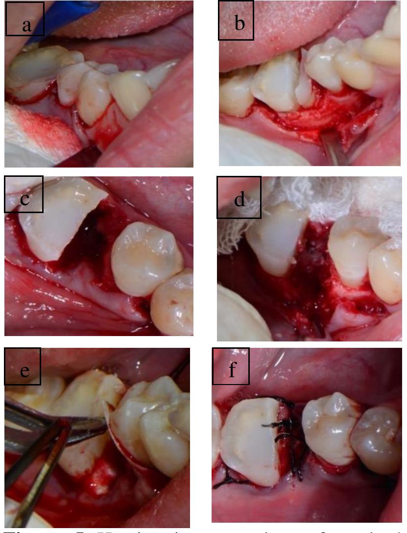 Tooth Hemisection (PDF) Hemisection as an Alternative Management for Mandibular First ...