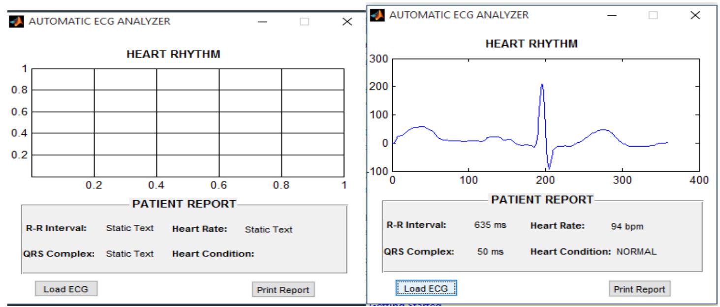 (PDF) Design and Simulation of Electrocardiogram Circuit with Automatic ...
