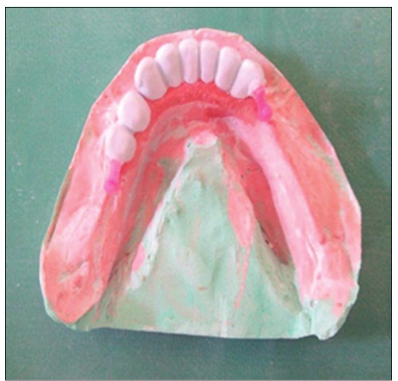 Wax Pattern Rpd (PDF) Attachment Retained Cast Partial Denture Prosthesis