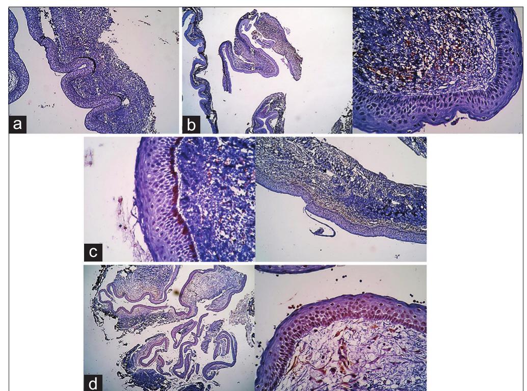 (PDF) Comparison of immunohistochemical expression of CD10 in ...