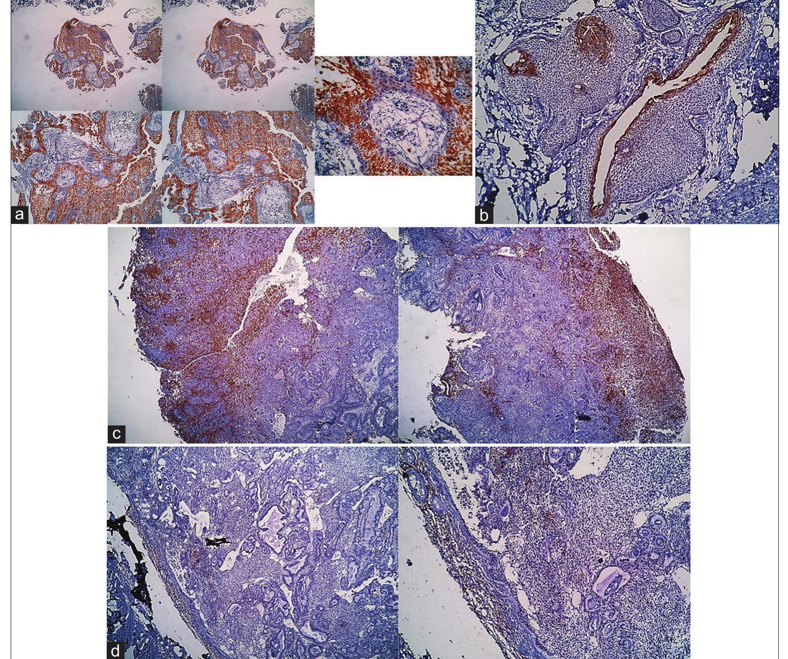 (PDF) Comparison of immunohistochemical expression of CD10 in ...