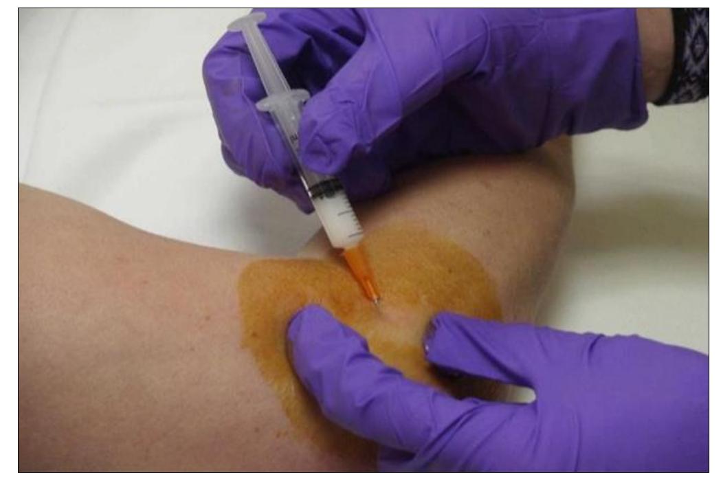 Supinator Injection (PDF) Comparative study of local corticosteroid injection and ...