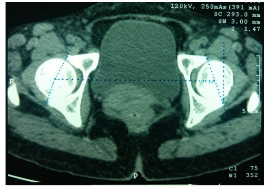 Normal Acetabulum Radiograph Measurement of acetabular version in ct-scan image ‘ig. 5:
